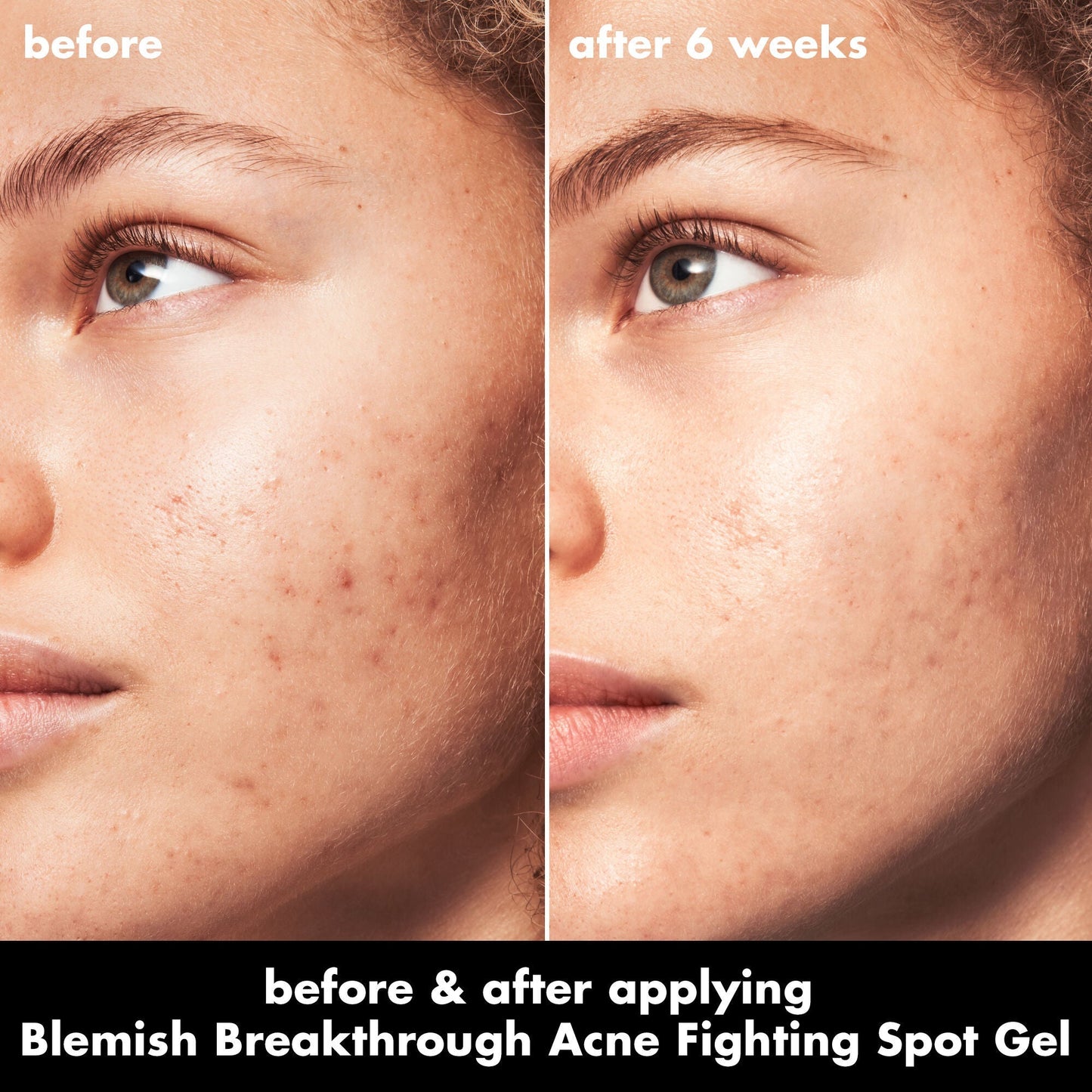 blemish-breakthrough-acne-fighting-spot-gel-n8 0326_EDU_BB_SpotGel_BA_MARLEY.jpg