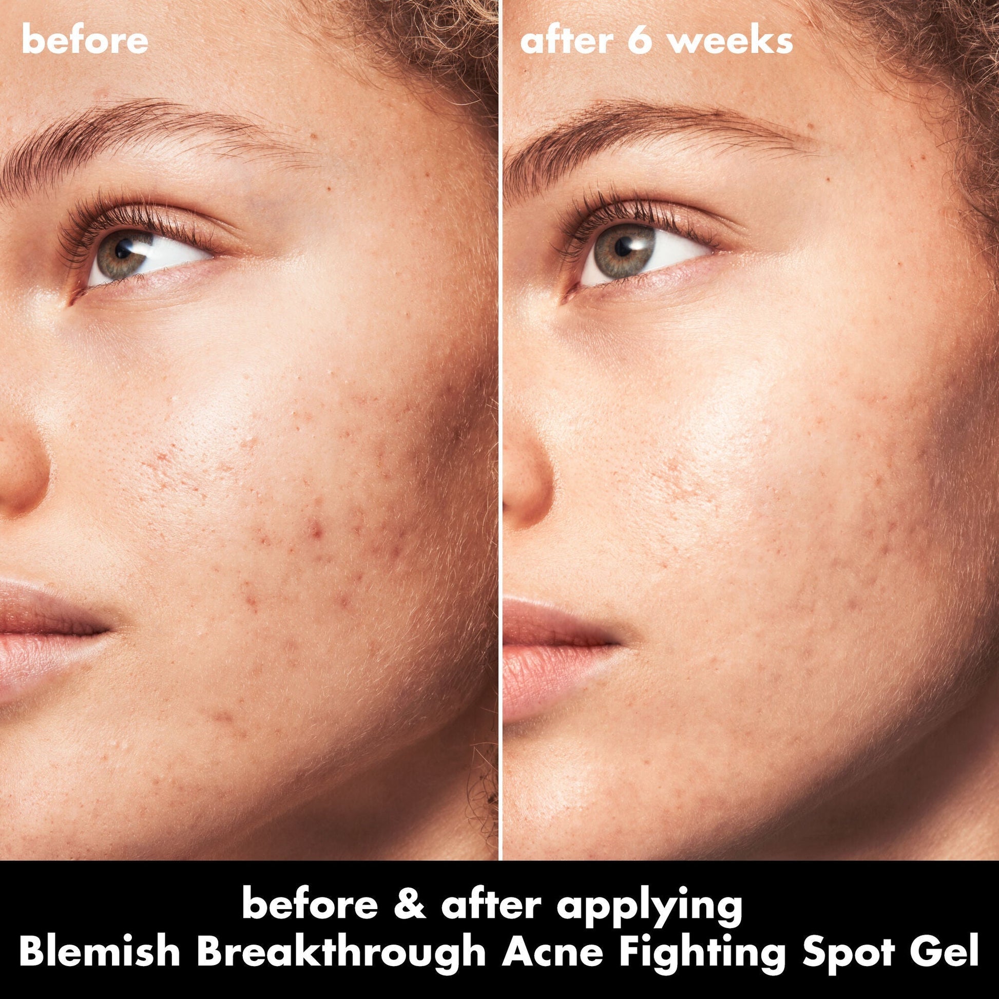 blemish-breakthrough-acne-fighting-spot-gel-n8 0326_EDU_BB_SpotGel_BA_MARLEY.jpg