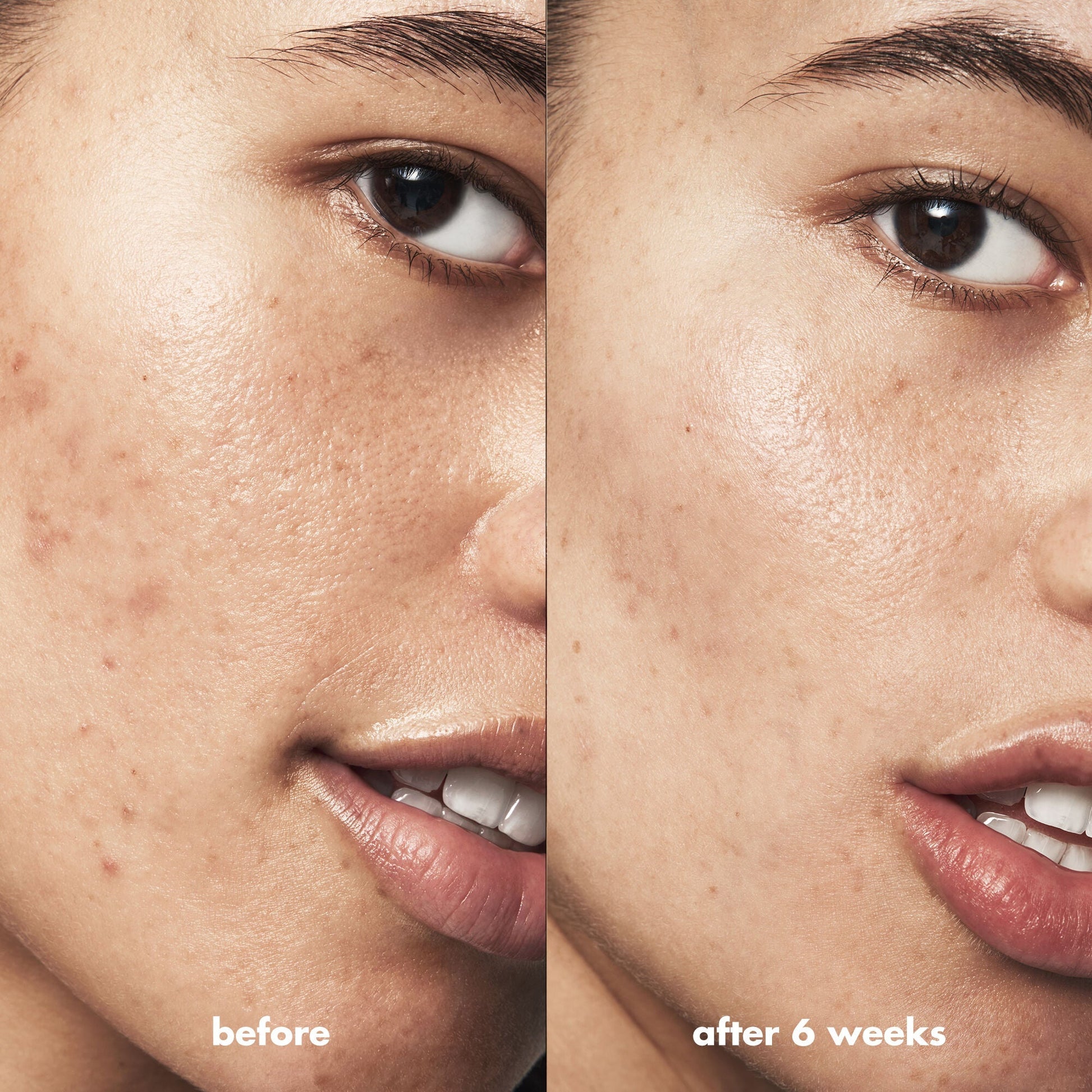 blemish-breakthrough-acne-clarifying-cleanser-h8 Acne_PDP_Isabella_Before_After_a3ff322b-cc6f-4b1a-9db3-bfb66c15d034.jpg
