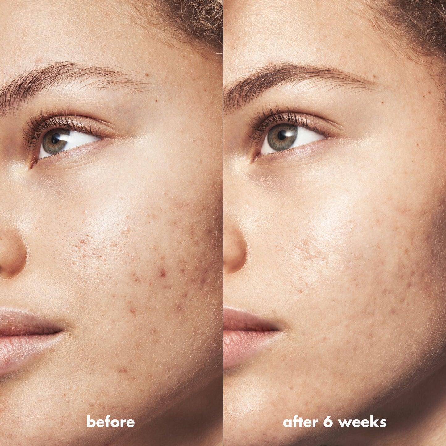 blemish-breakthrough-acne-calming-water-cream-w5 Acne_PDP_Marley_Before_After_be0f6ee7-ce12-4695-83d7-5ec5f0498e19.jpg